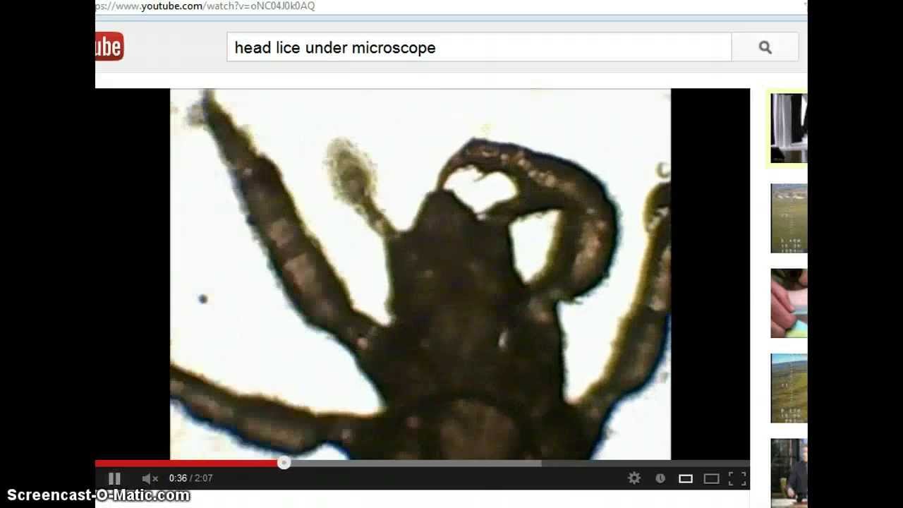 Creepy Video - How To Get Rid Of Lice Fast! - YouTube