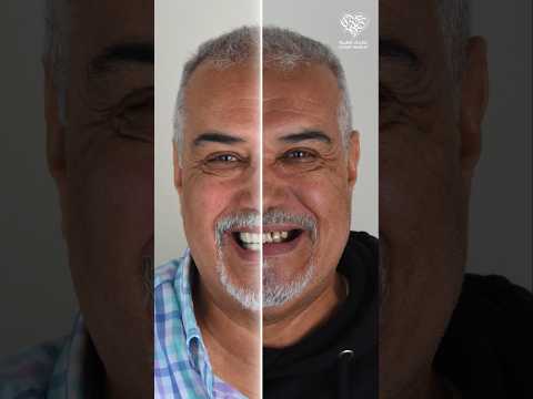 ابتسامة هوليود قبل وبعد نتيجة تركيب تيجان الزيركون