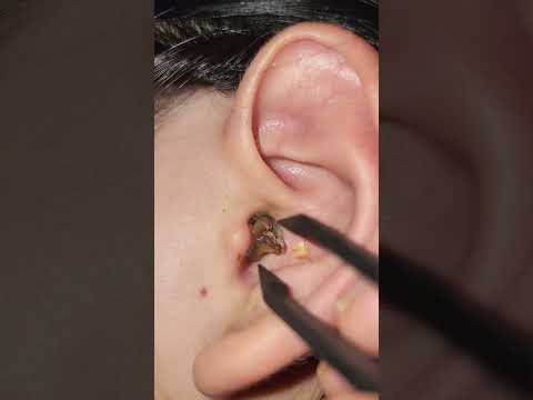 تمیز کردن گوش به طریقه خیلی آسان