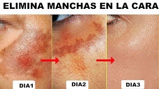 ELIMINA LAS MANCHAS DE LA CARA (PIGMENTACION)EN 3 DIAS.