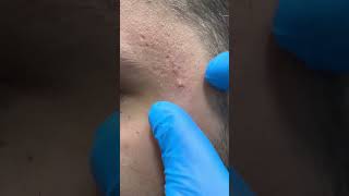#waxing #ingrownhair #trending #hair #beard #remove #asmr #hairremoval #maazsafder #natural NK.084