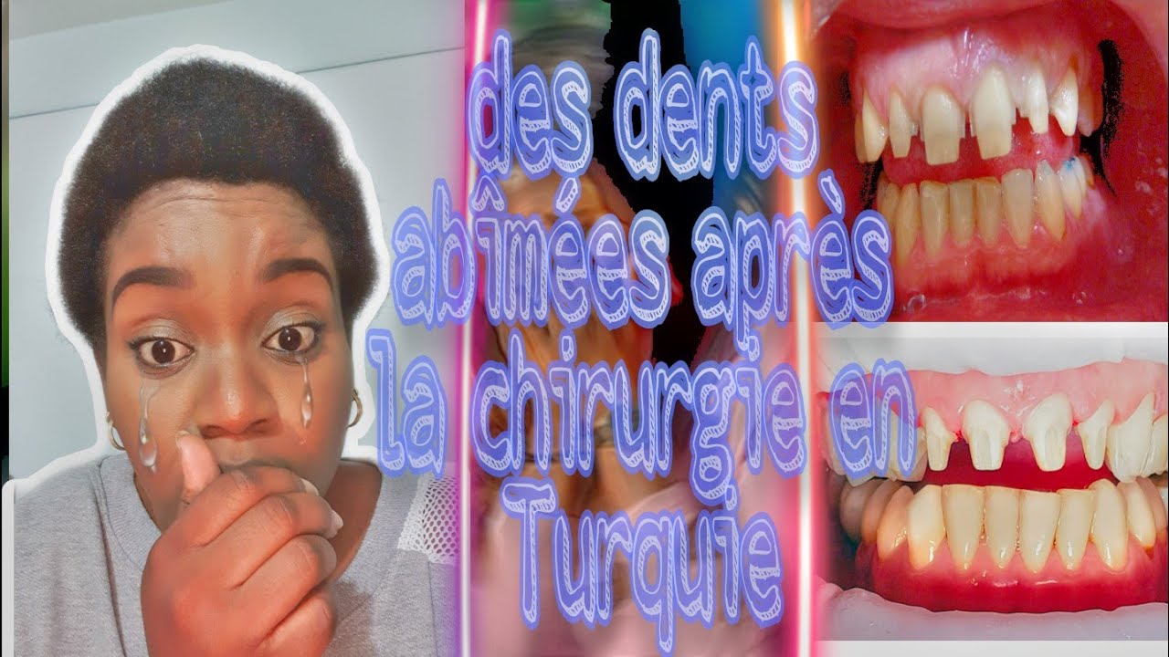#operation #facette... #invisalign DES DENTS DÉTRUIT CHIRURGIE TURQUIE