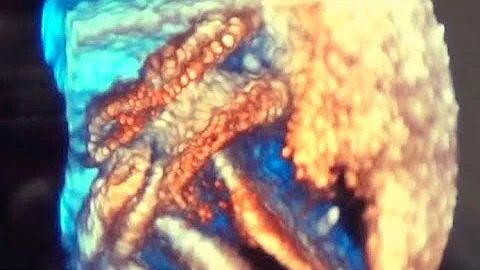 An Overview of PFO Closure to Treat Cryptogenic St...