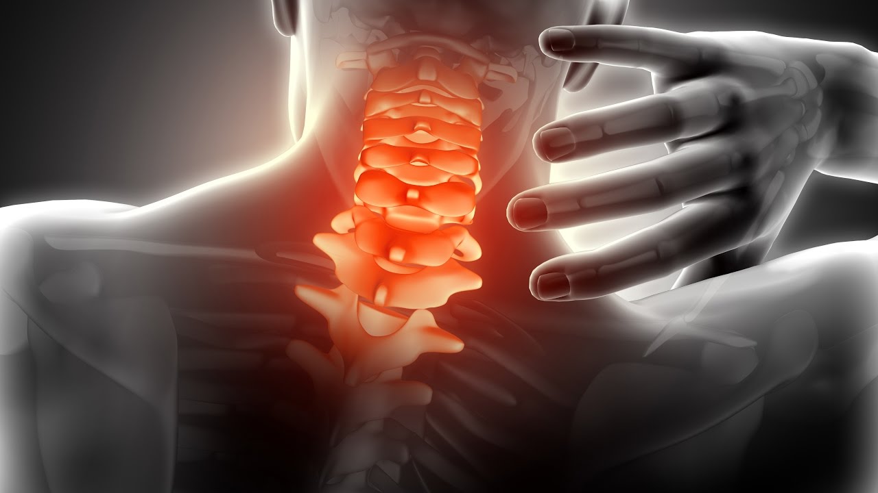 Cervical Spondolysis Ayurvedic Treatment YouTube