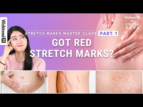 Video: Red Stretch Marks: Penyebab, Perawatan, Dan Pemulihan Rumah