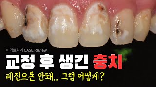 치아교정 후 충치가?! | 앞니 올세라믹 크라운+라미네이트, 레진 (치아우식증)