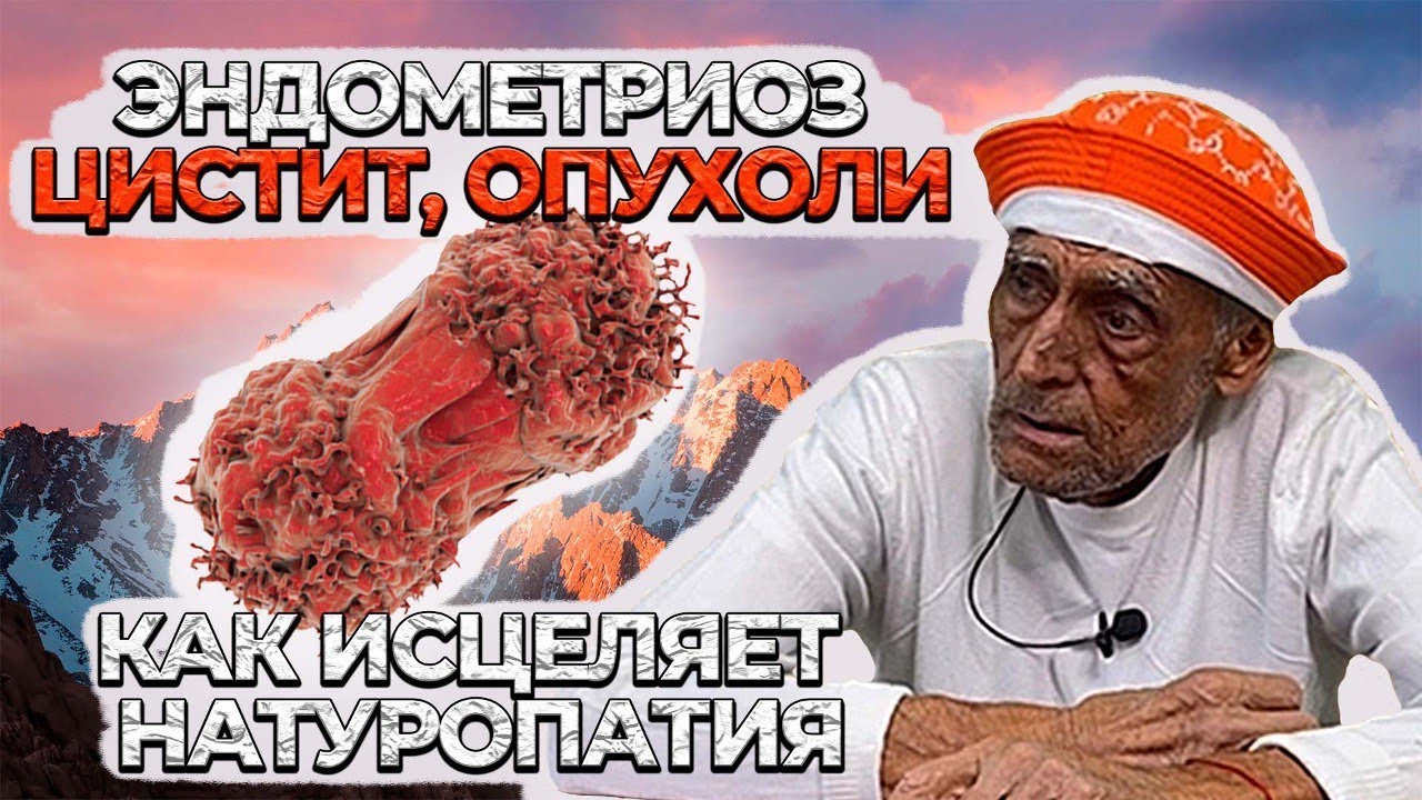 ЭНДОМЕТРИОЗ, цистит, опухоли как лечить? - YouTube