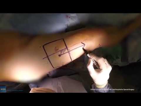 Locking Screws Localization of Magnet and Iliotibial Band Release: Live Surgery - Locking Screws Localization of Magnet and Iliotibial Band Release: Live Surgery