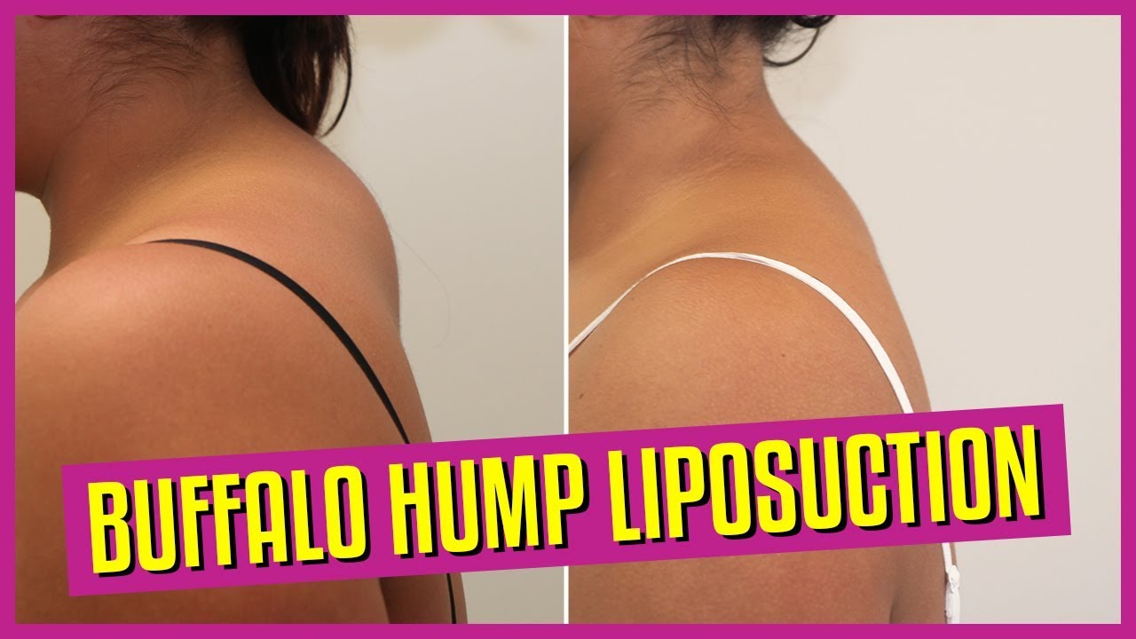 Buffalo hump Video & Image