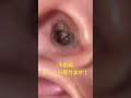 【閲覧注意】【耳掃除】次、この巨大耳垢を新春にやっと捕獲できました。I will capture this earwax　#asmr #clean #ear #wax #耳垢 #耳かき #shorts