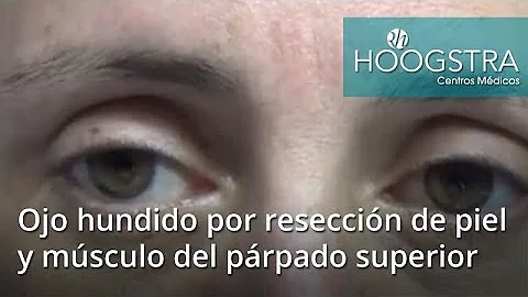 ¿Qué son los ojos hundidos?