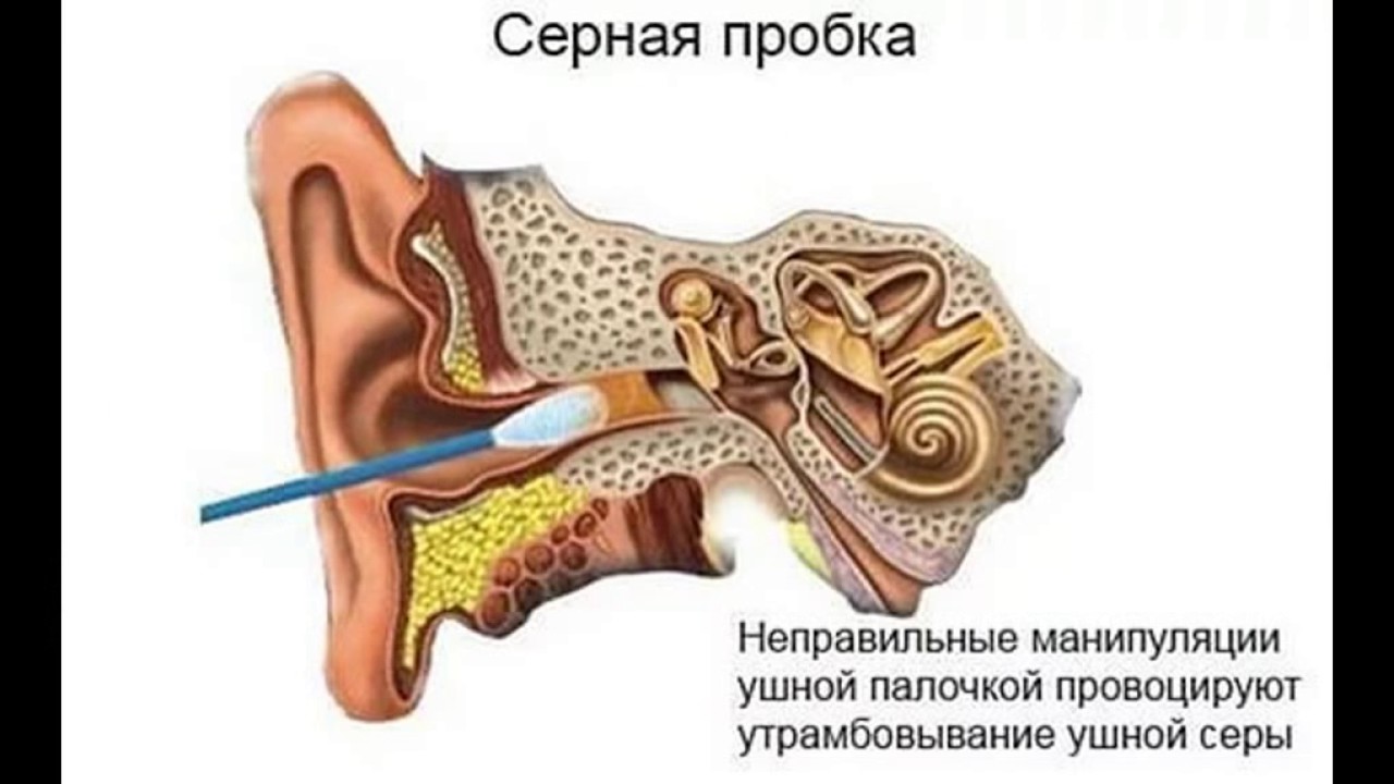 Прочистить пробки в ушах в домашних условиях. Строение уха ушная пробка. Серная пробка на барабанной перепонке. Внутреннее ухо серная пробка. Ушная сера в барабанной перепонке.