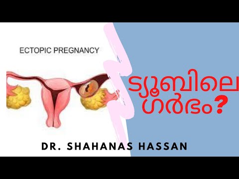 TUBAL PREGNANCY ട്യൂബല്‍ പ്രെഗ്നന്‍സി ECTOPIC PREGNANCY MALAYALAM #TubalPregnancy #DrShahanasHassan