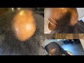 How to do Lemonade Braids, On someone with Severe Traction Alopecia