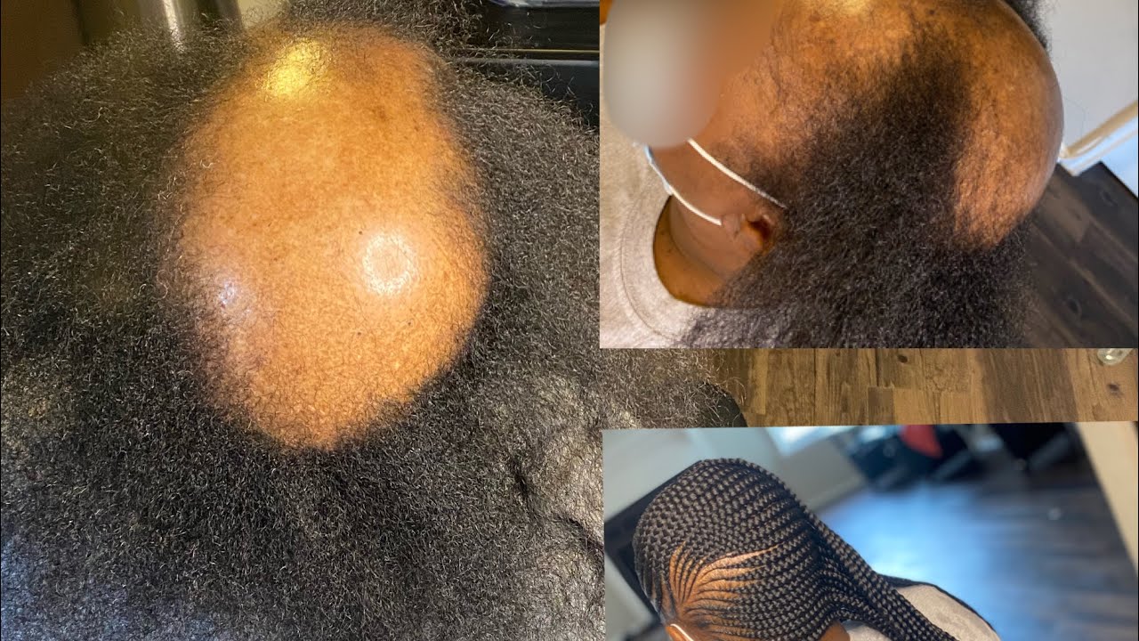 How to do Lemonade Braids, On someone with Severe Traction Alopecia