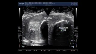 Ultrasound Video showing a Large Calcified Fibroids.