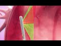 Philips 3D ICE Verisight Pro Catheter for LAA Closure: Step-by-step