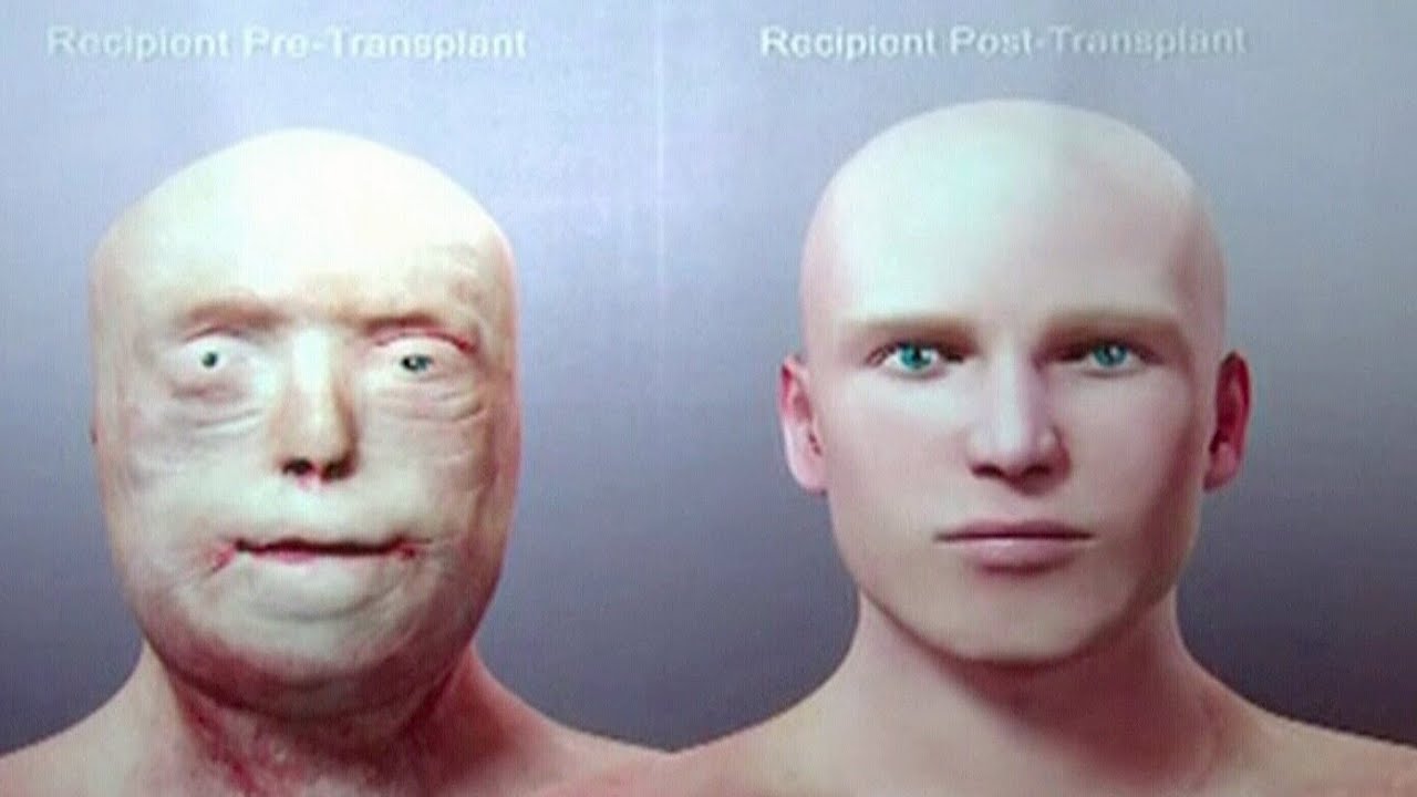 Как выглядит кожа после пересадки Canada AM looks at the biggest medical stories of 2015 - YouTube