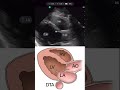 Parasternal Long Axis with Handheld Ultrasound Exo Iris®