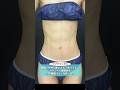 脂肪吸引で美しい腹筋を手に入れよう！ #shorts #脂肪吸引 #腹筋