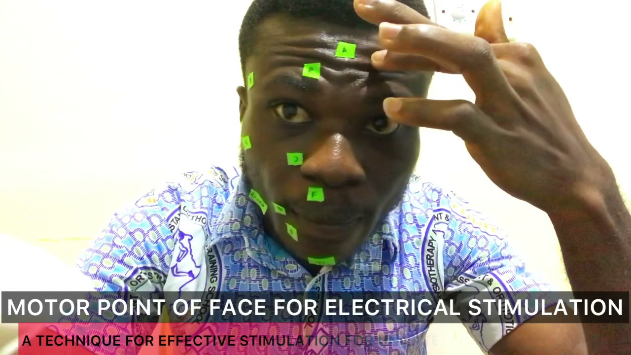 Motor points of the face for electrical stimulation in Bell’s or Facial