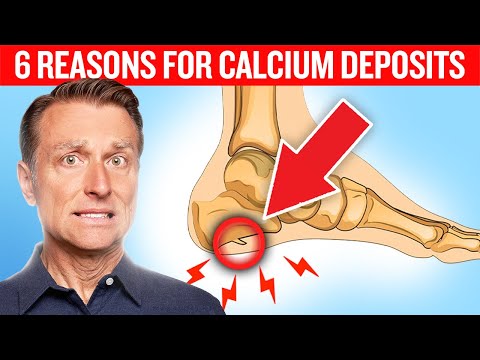 6 Reasons for Calcium Deposits (Spurs, Osteophytes, Stones, and Tartar)