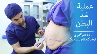 Abdominoplasty I عملية و شد البطن I نەشتەرگەری و جوانکاری توندکردنەوەی سک