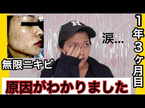 無限ニキビ 肌荒れの原因をついに突き止めました Youtube