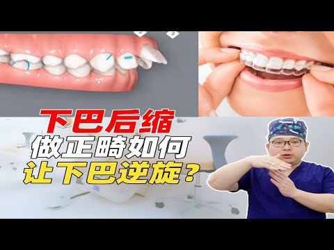 下巴后缩，正畸如何让下巴逆时针旋转，导出下巴？