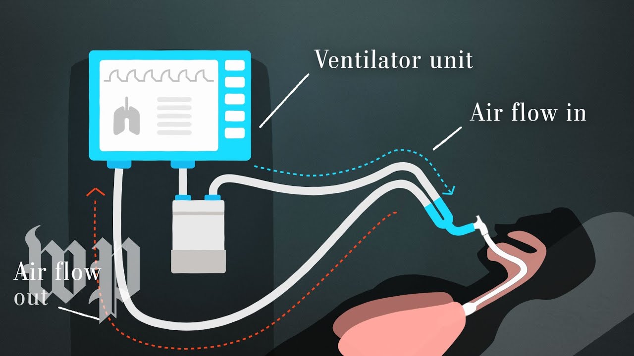 How does mechanical ventilation work during an operation?