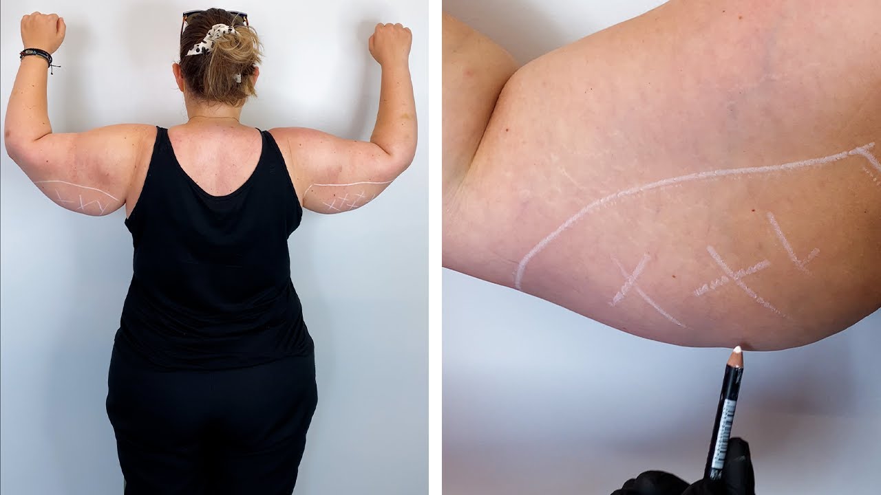 Πώς να χάσω Λίπος από τα Μπράτσα #shorts #fatloss #skintightening