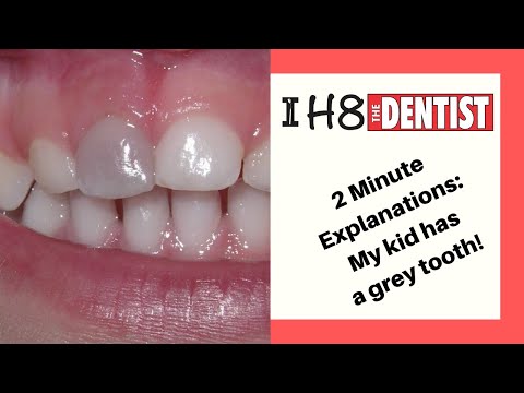 Video: Bruised Tooth: Definice, Příčiny A Léčba