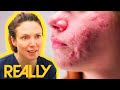 &quot;I Can&#39;t Escape It!&quot; Woman Feels Like Less Of A Person Due To Severe Acne | The Bad Skin Clinic