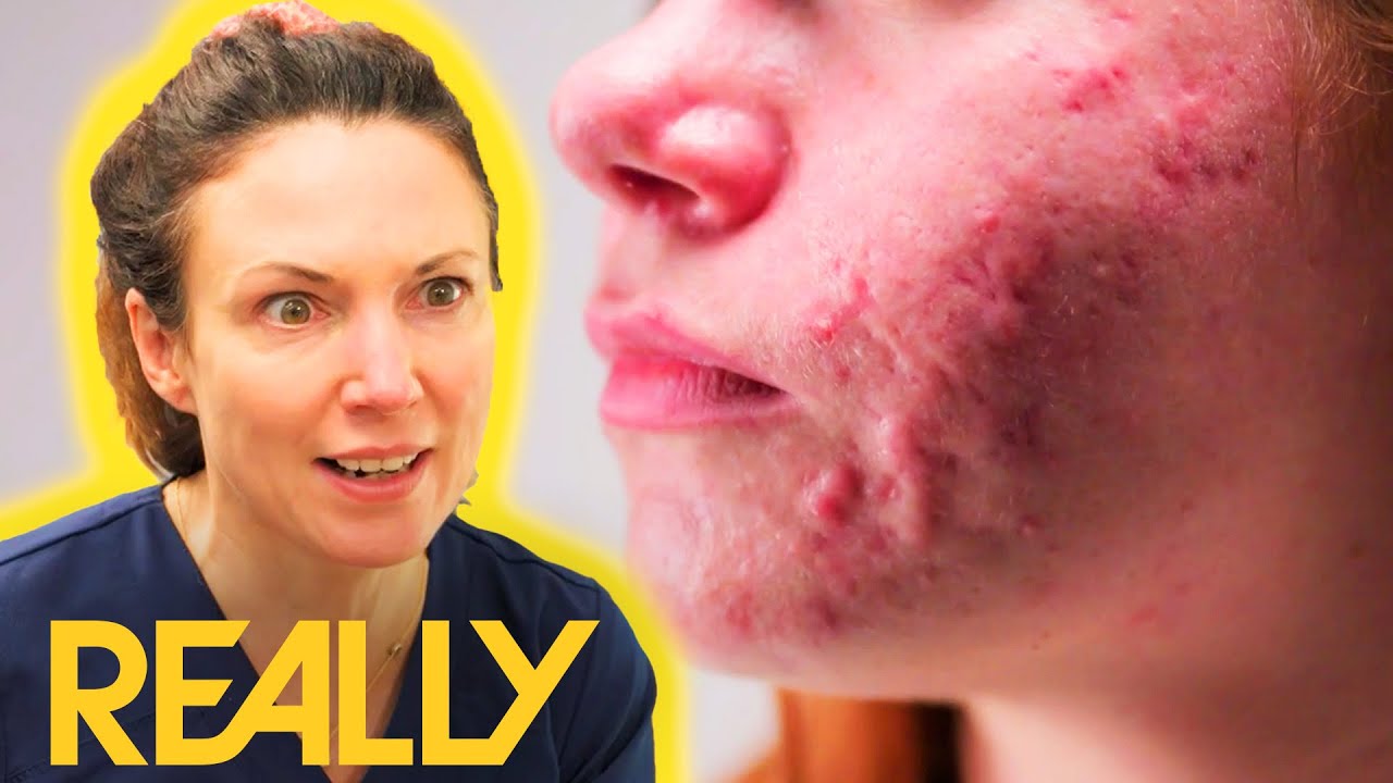 "I Can't Escape It!" Woman Feels Like Less Of A Person Due To Severe Acne The Bad Skin Clinic