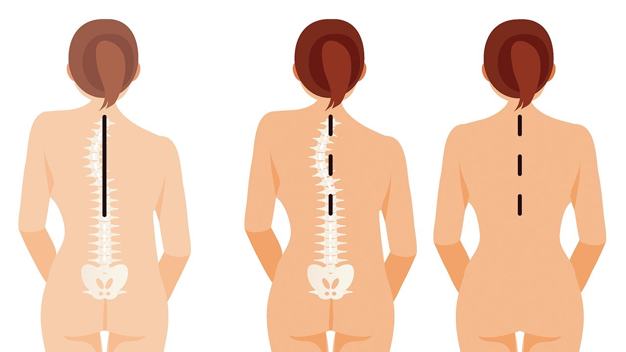 Minimally Invasive Scoliosis Surgery – Dr. Matthew Geck of Texas Spine and Scoliosis