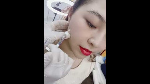 Tiêm filler căn chỉnh má hóp