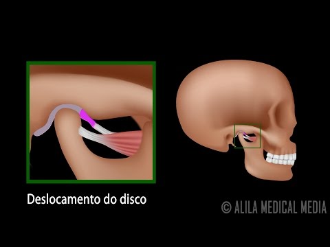 Vídeo: Distúrbios Da Articulação Temporomandibular Em Cães