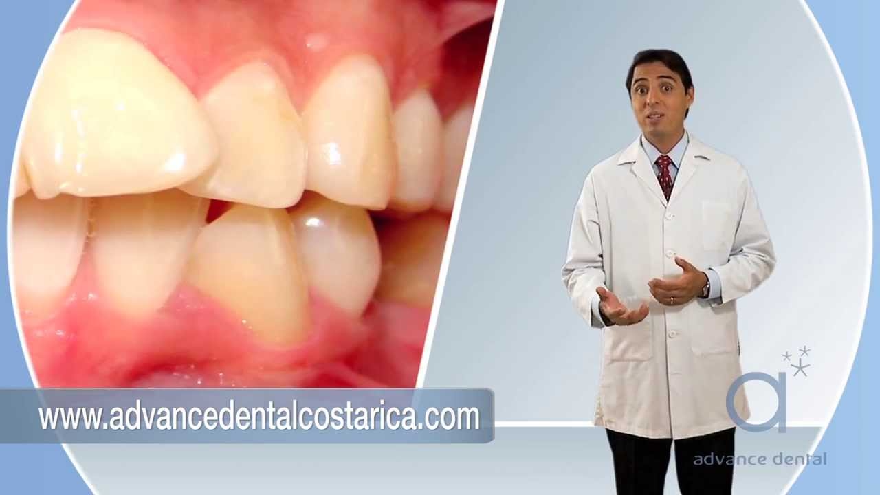 Porcelain Veneers at Advance Dental Costa Rica YouTube