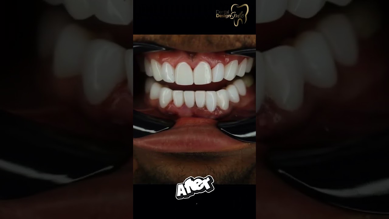 Smile Goals: Get Your Veneers