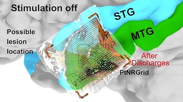 Super high resolution brain sensing grids - Shadi Dayeh lab