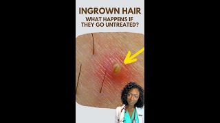 Ingrown Hair: What Happens If They Go Untreated? #Shorts