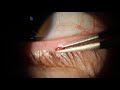 Remove one eyelid cyst in one minute