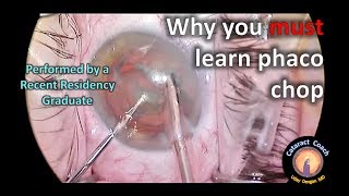 Why you MUST learn Phaco-Chop (Resident Cataract Surgery Case)