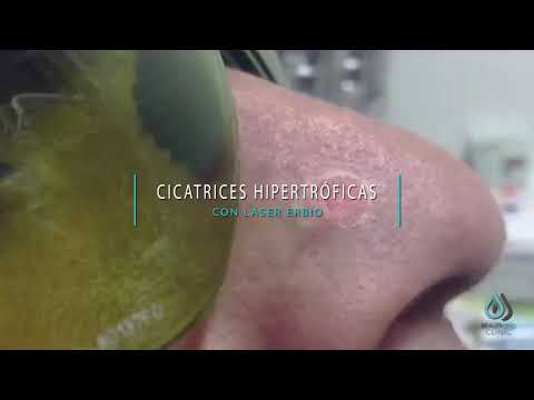 Cicatrices Hipertróficas