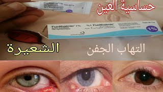مرهم للعين 👍علاج التهاب العين والتعفنات والشعيرة👀