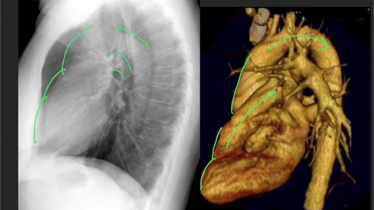 normal chest xray labeled