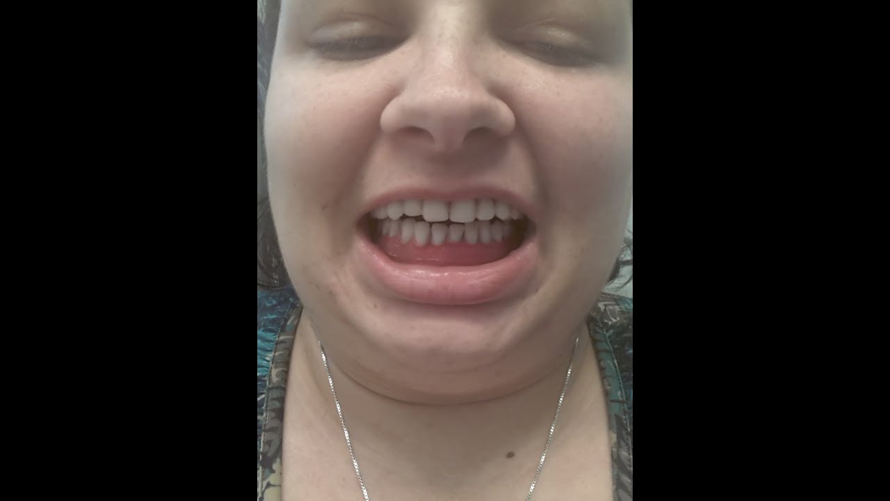 Dentures by Mail Update ( YouTube