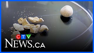 Minimally Invasive Procedure Could Change Kidney Stone Treatments