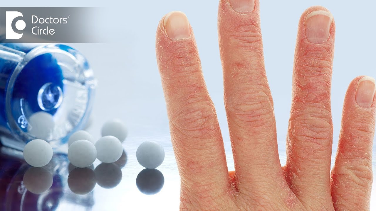 How is eczema treated by homeopathy? - Dr. Jayashree Rao