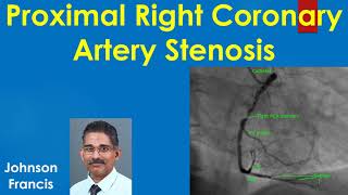 Proximal Right Coronary Artery Stenosis